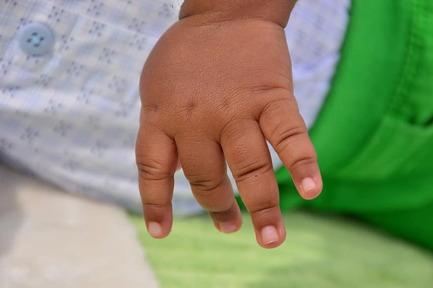 Conjoined twins born in Jane Furse to be transferred to Mankweng