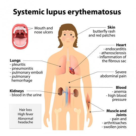 Lupus illustration