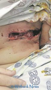 Henning went for her reconstruction after she had her double Mastectomy done.