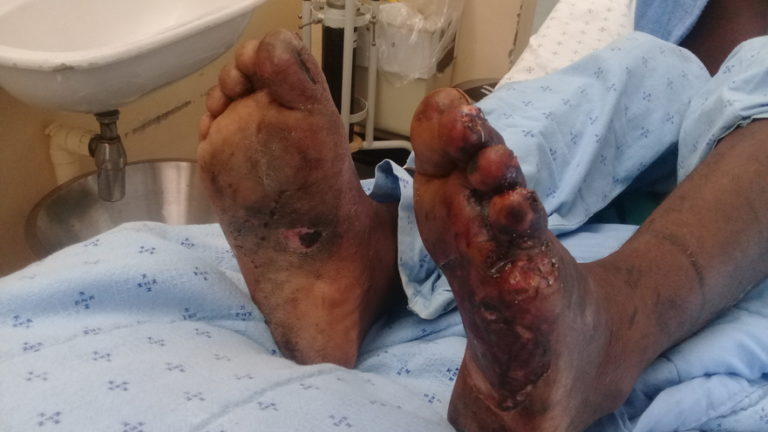 The Dukuduku housebreaking suspect was tortured so badly, his toes had to be amputated Picture: SAPS